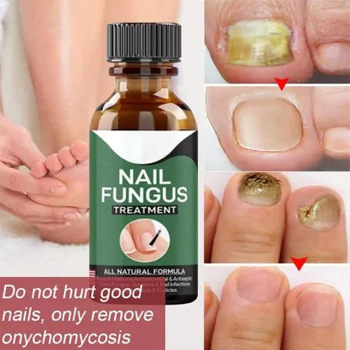 Nail Fungal Repair Serum | Nail Fungus Removal Gel